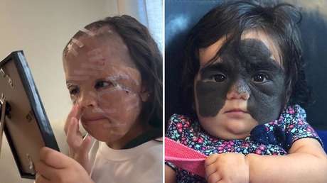 VIDEO: ‘La niña de la máscara de Batman’ muestra su nueva cara tras el éxito de los cirujanos rusos